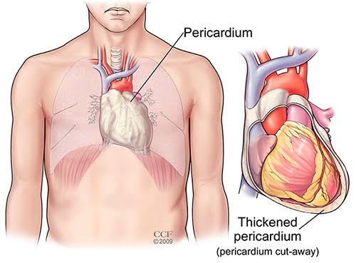 Pericarditis | RMI