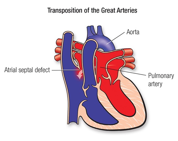 Transposition of the Great Arteries | RMI