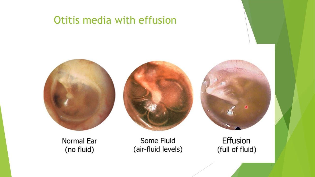 fluid behind eardrum in adults