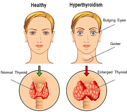 Hyperthyroidism Rmi